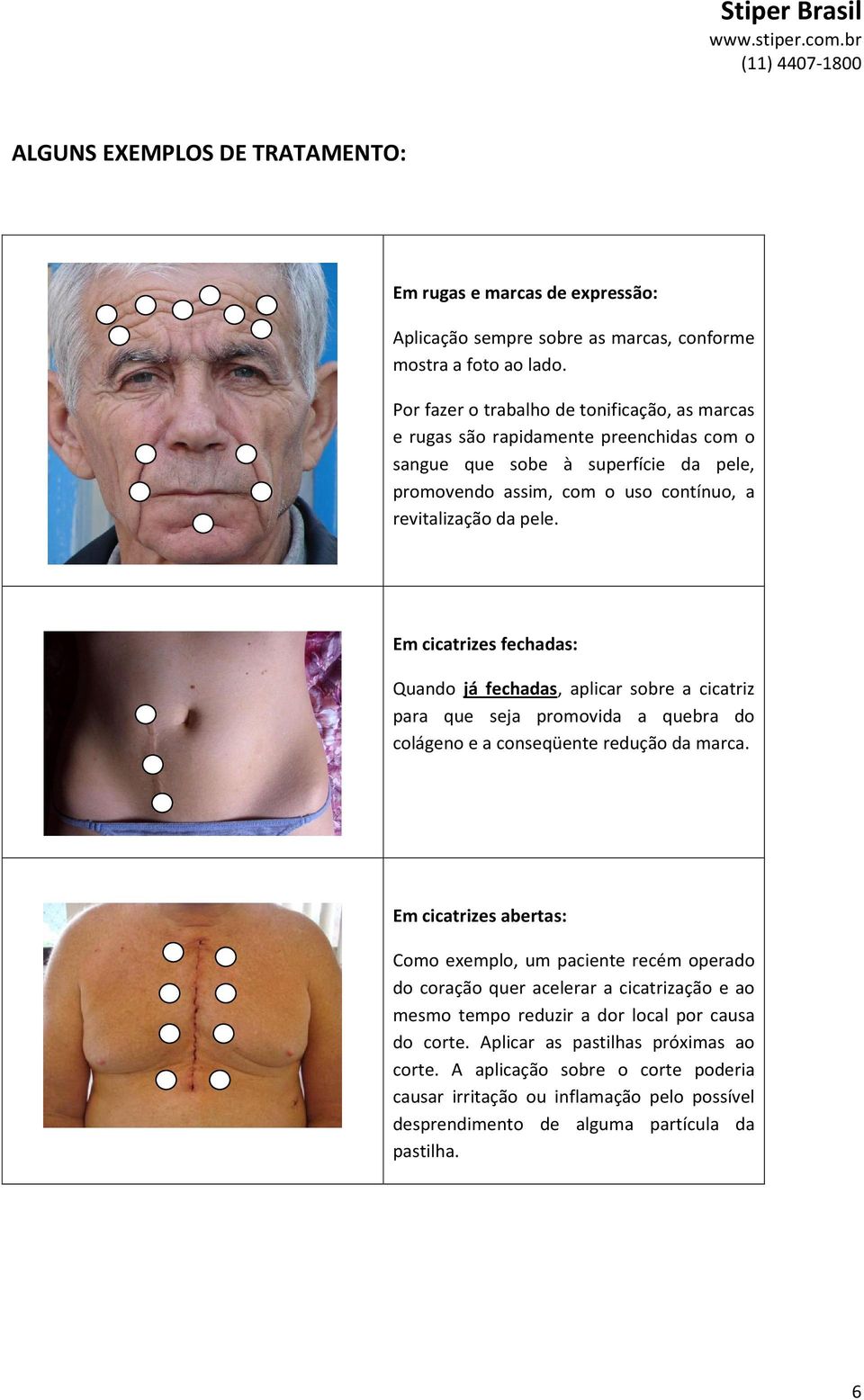 Em cicatrizes fechadas: Quando já fechadas, aplicar sobre a cicatriz para que seja promovida a quebra do colágeno e a conseqüente redução da marca.