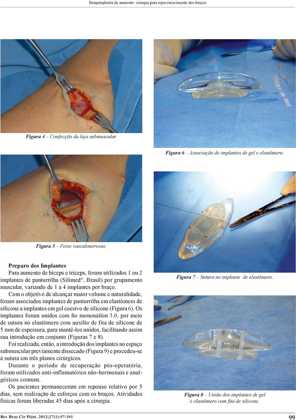 Com o objetivo de alcançar maior volume e naturalidade, foram associados implantes de panturrilha em elastômero de silicone a implantes em gel coesivo de silicone (Figura 6).