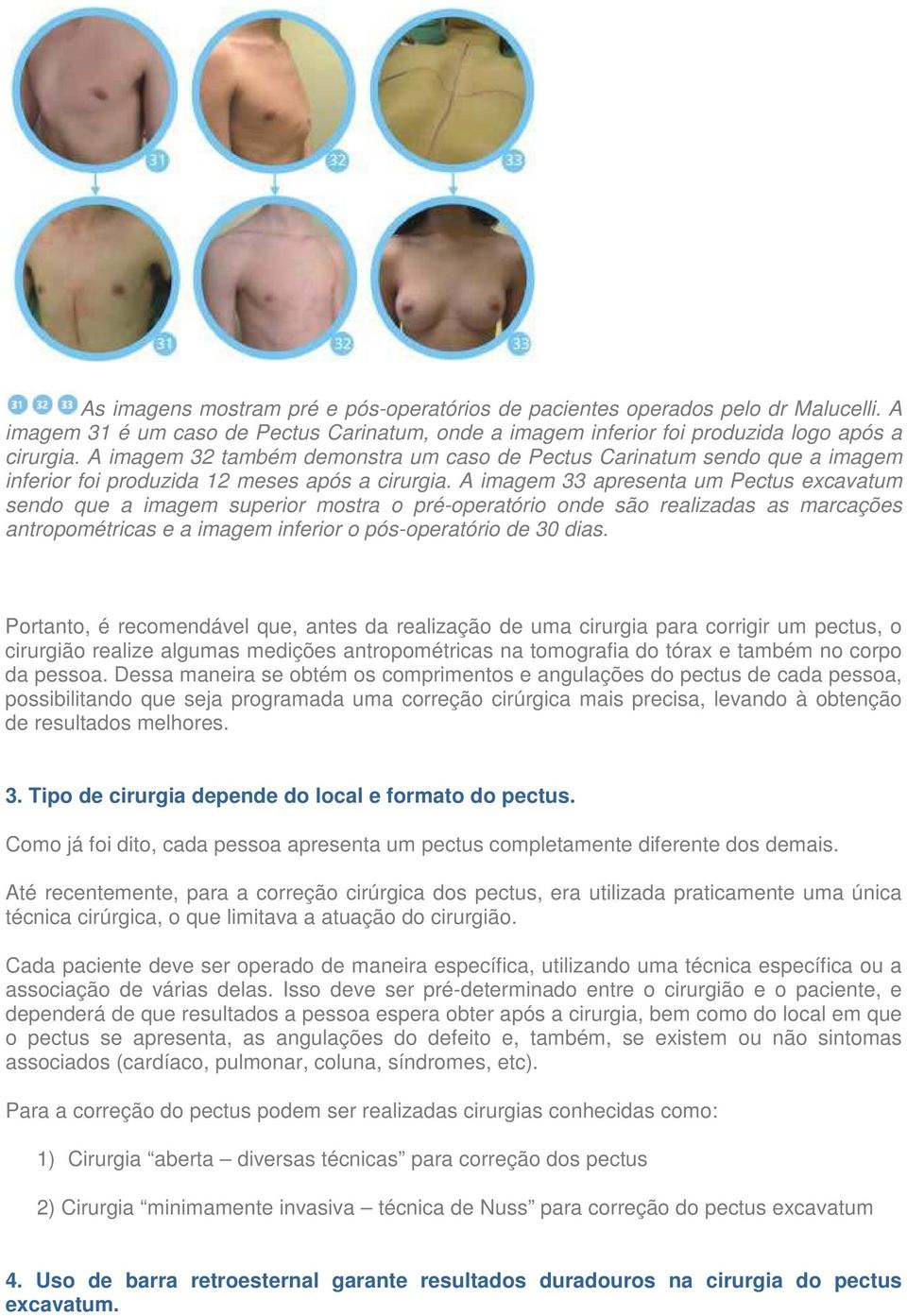 A imagem 33 apresenta um Pectus excavatum sendo que a imagem superior mostra o pré-operatório onde são realizadas as marcações antropométricas e a imagem inferior o pós-operatório de 30 dias.