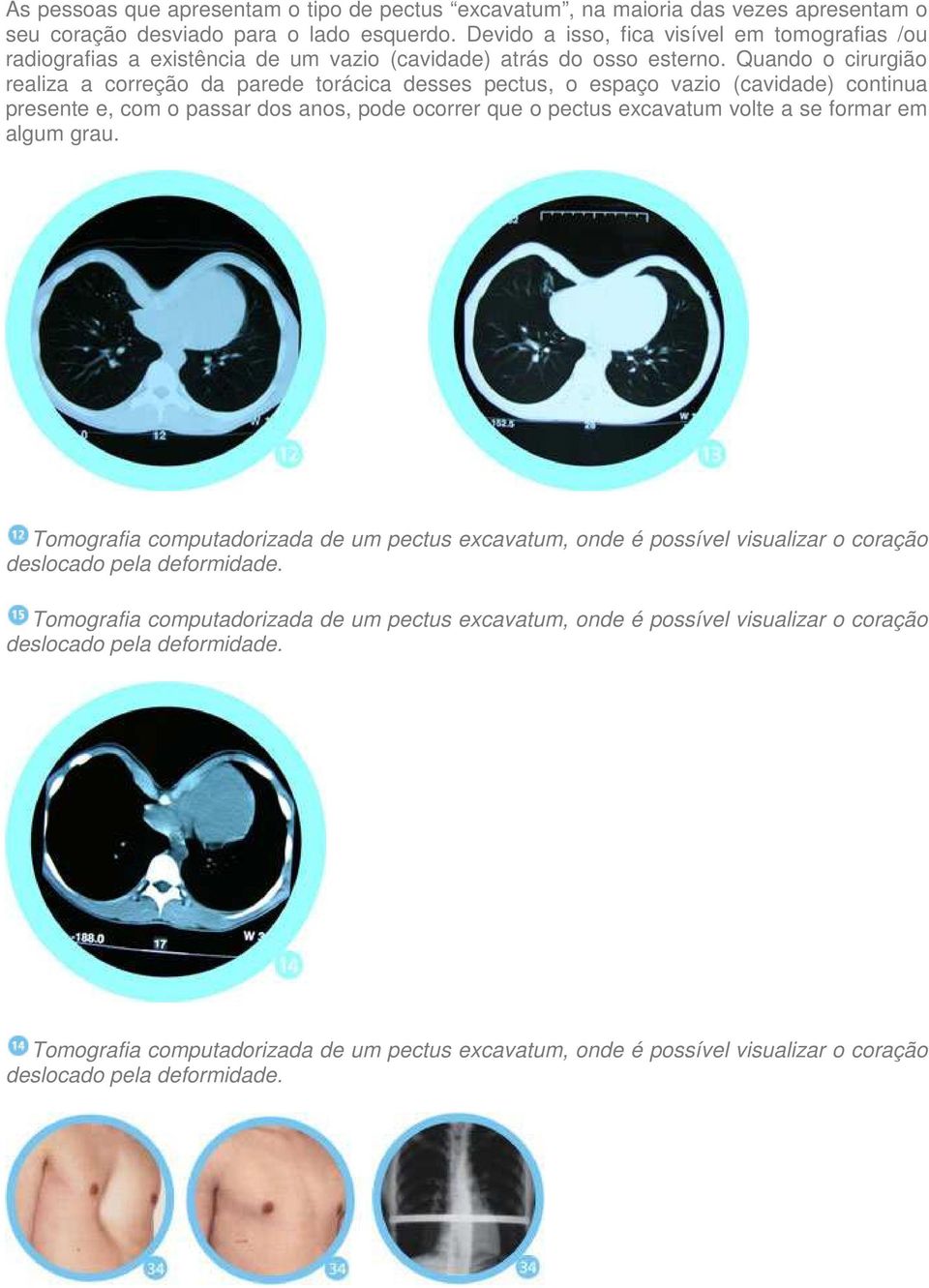 Quando o cirurgião realiza a correção da parede torácica desses pectus, o espaço vazio (cavidade) continua presente e, com o passar dos anos, pode ocorrer que o pectus excavatum volte a se formar em