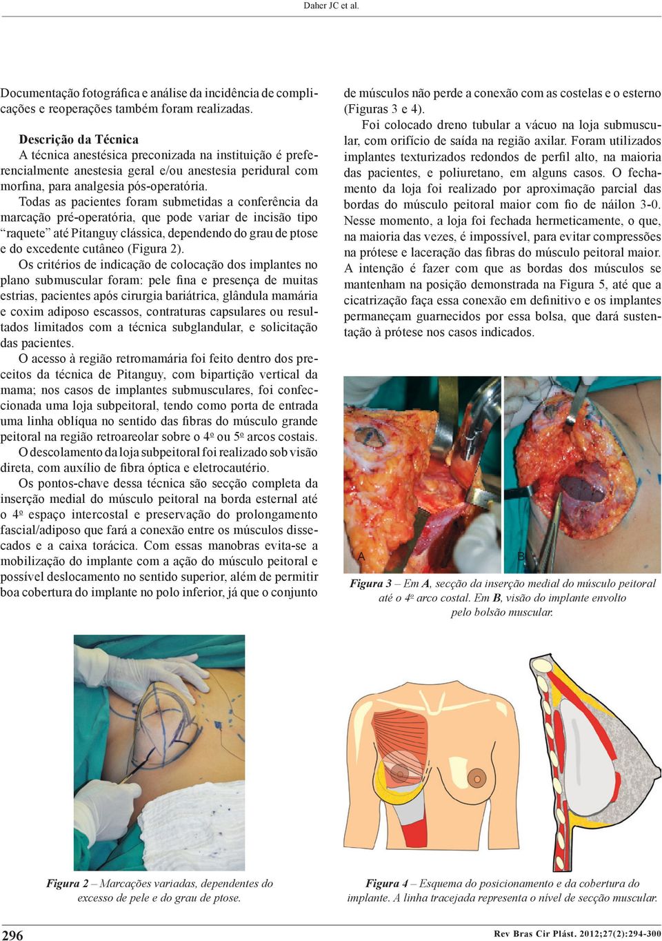 Todas as pacientes foram submetidas a conferência da marcação pré-operatória, que pode variar de incisão tipo raquete até Pitanguy clássica, dependendo do grau de ptose e do excedente cutâneo (Figura