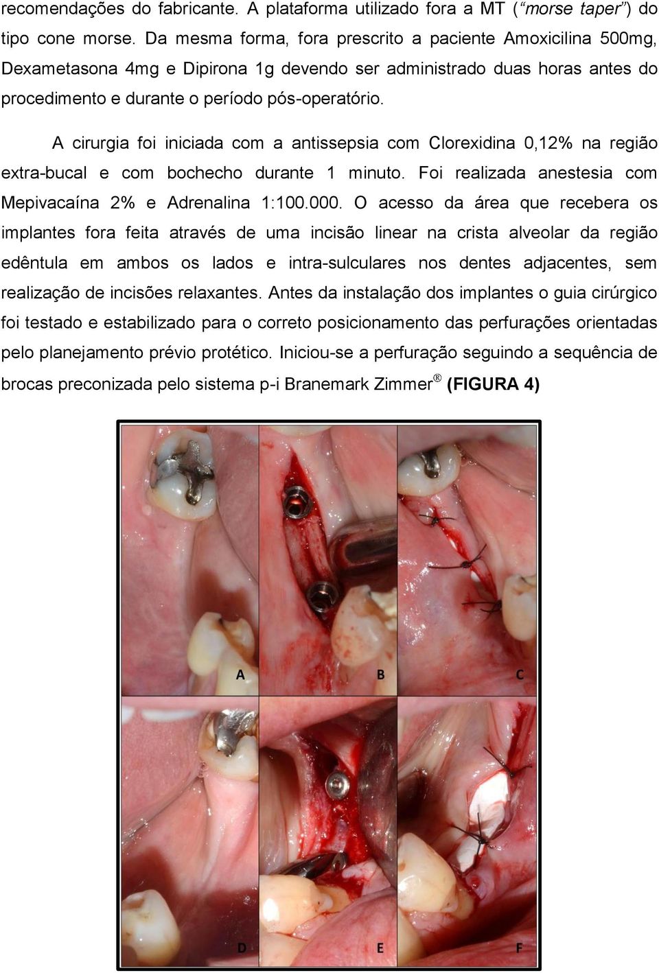 A cirurgia foi iniciada com a antissepsia com Clorexidina 0,12% na região extra-bucal e com bochecho durante 1 minuto. Foi realizada anestesia com Mepivacaína 2% e Adrenalina 1:100.000.