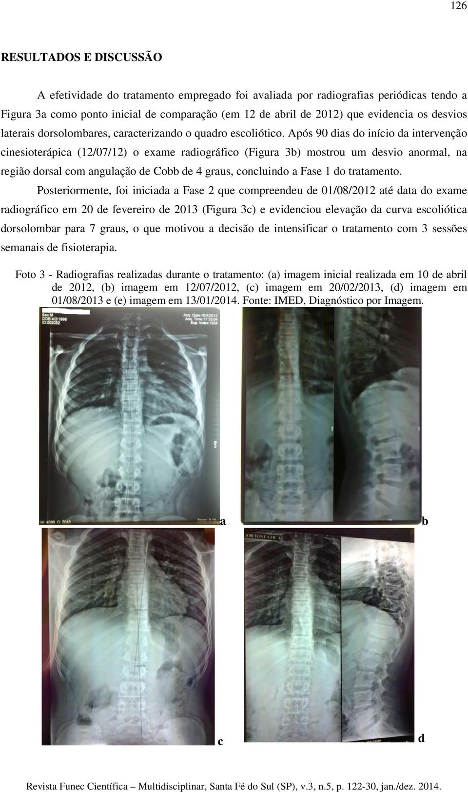 Após 90 dias do início da intervenção cinesioterápica (12/07/12) o exame radiográfico (Figura 3b) mostrou um desvio anormal, na região dorsal com angulação de Cobb de 4 graus, concluindo a Fase 1 do