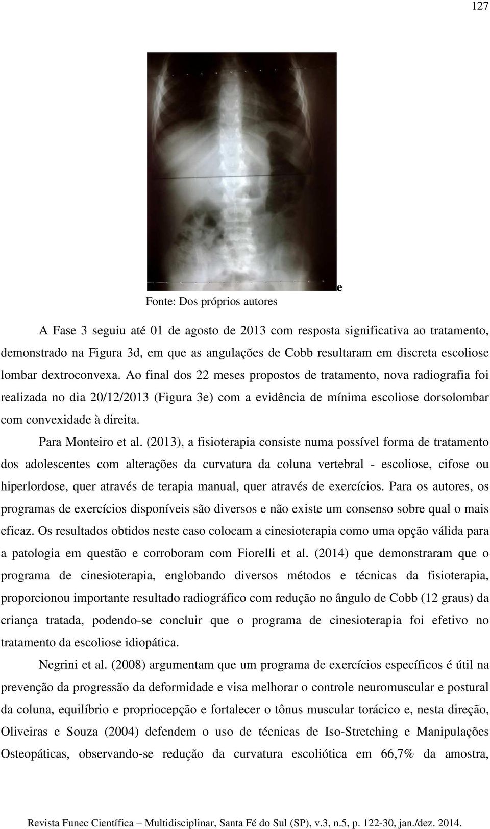 Ao final dos 22 meses propostos de tratamento, nova radiografia foi realizada no dia 20/12/2013 (Figura 3e) com a evidência de mínima escoliose dorsolombar com convexidade à direita.
