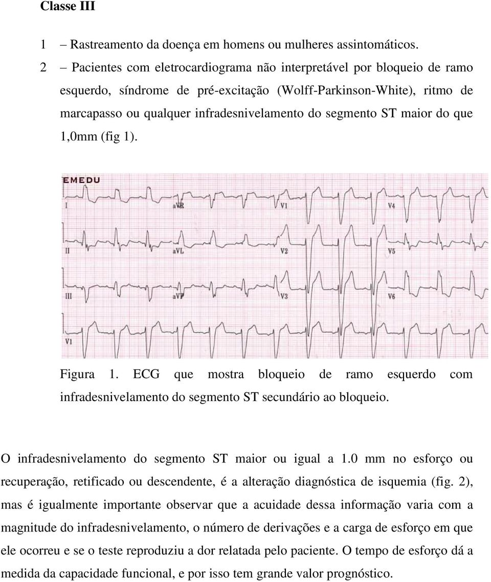 ST maior do que 1,0mm (fig 1). Figura 1. ECG que mostra bloqueio de ramo esquerdo com infradesnivelamento do segmento ST secundário ao bloqueio.