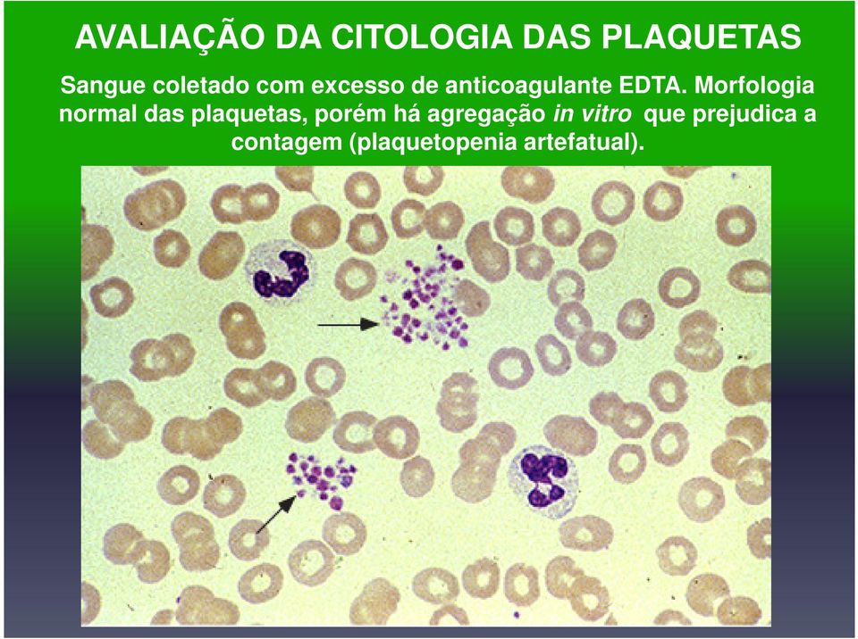 Morfologia normal das plaquetas, porém há