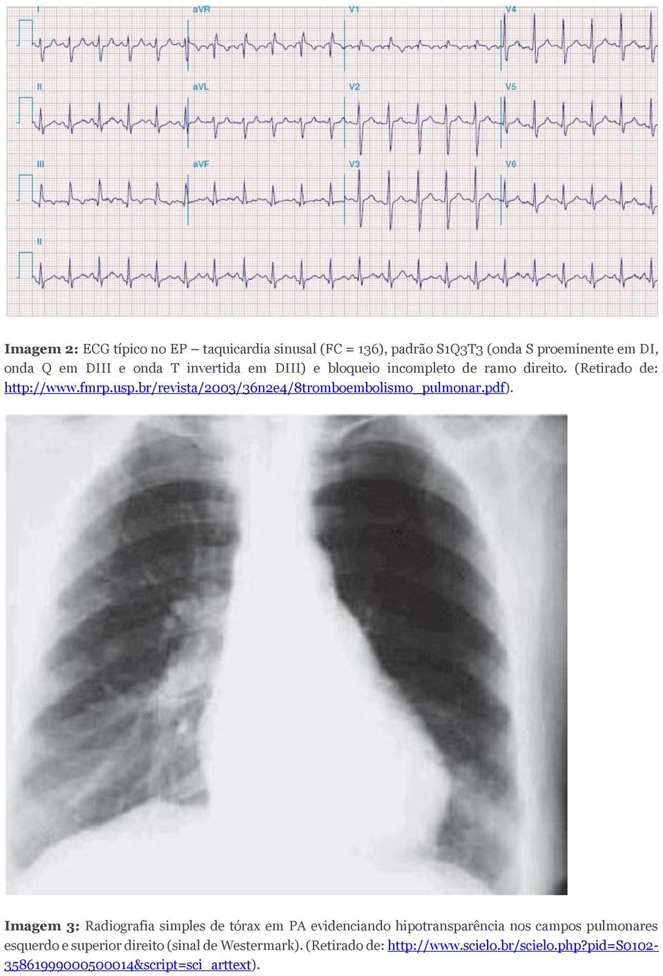 br/revista/2003/36n2e4/8tromboembolismo_pulmonar.pdf).