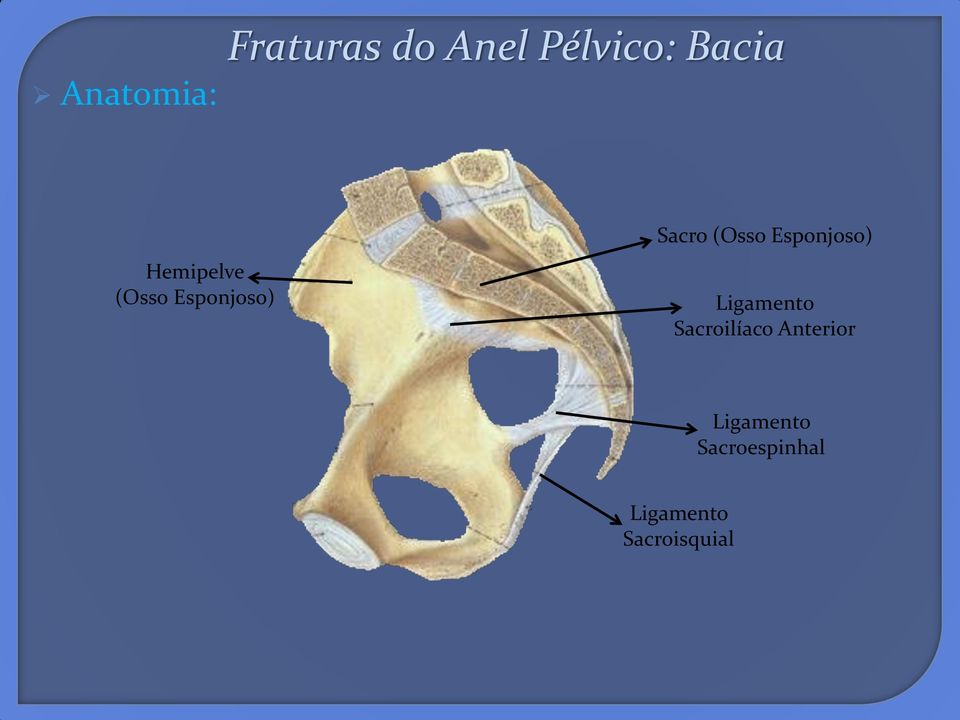 Esponjoso) Ligamento Sacroilíaco Anterior