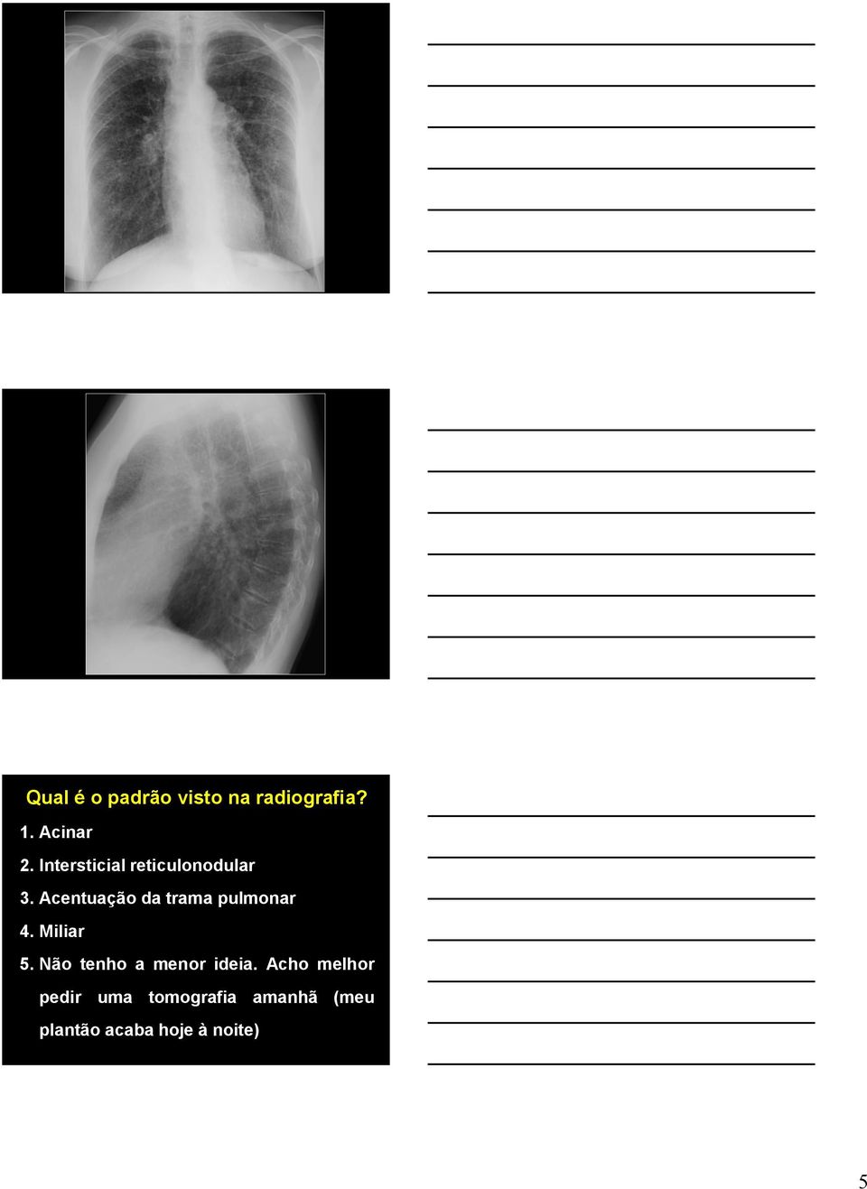 Acentuação da trama pulmonar 4. Miliar 5.