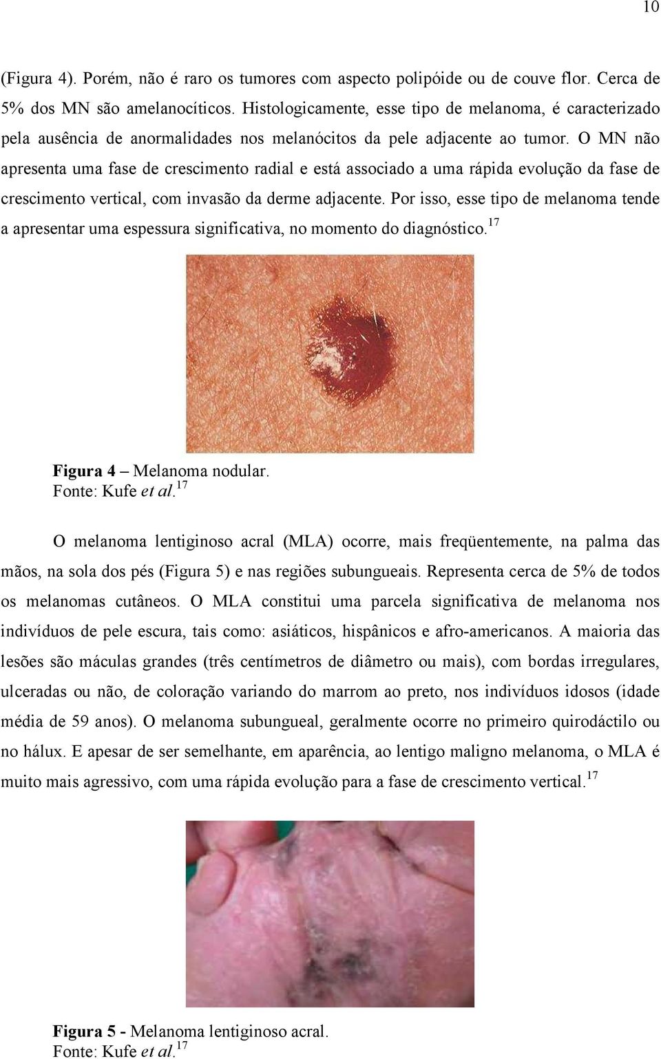 O MN não apresenta uma fase de crescimento radial e está associado a uma rápida evolução da fase de crescimento vertical, com invasão da derme adjacente.