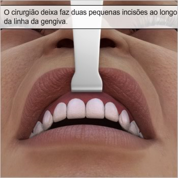 Incisões na linha do cabelo O lifting facial do terço médio pode ser realizado usando-se várias incisões e técnicas cirúrgicas diferentes.