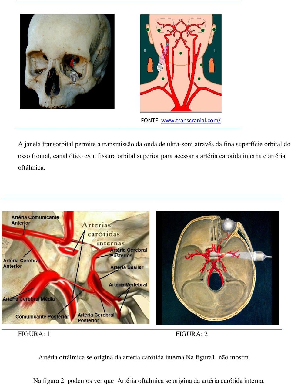 osso frontal, canal ótico e/ou fissura orbital superior para acessar a artéria carótida interna e artéria