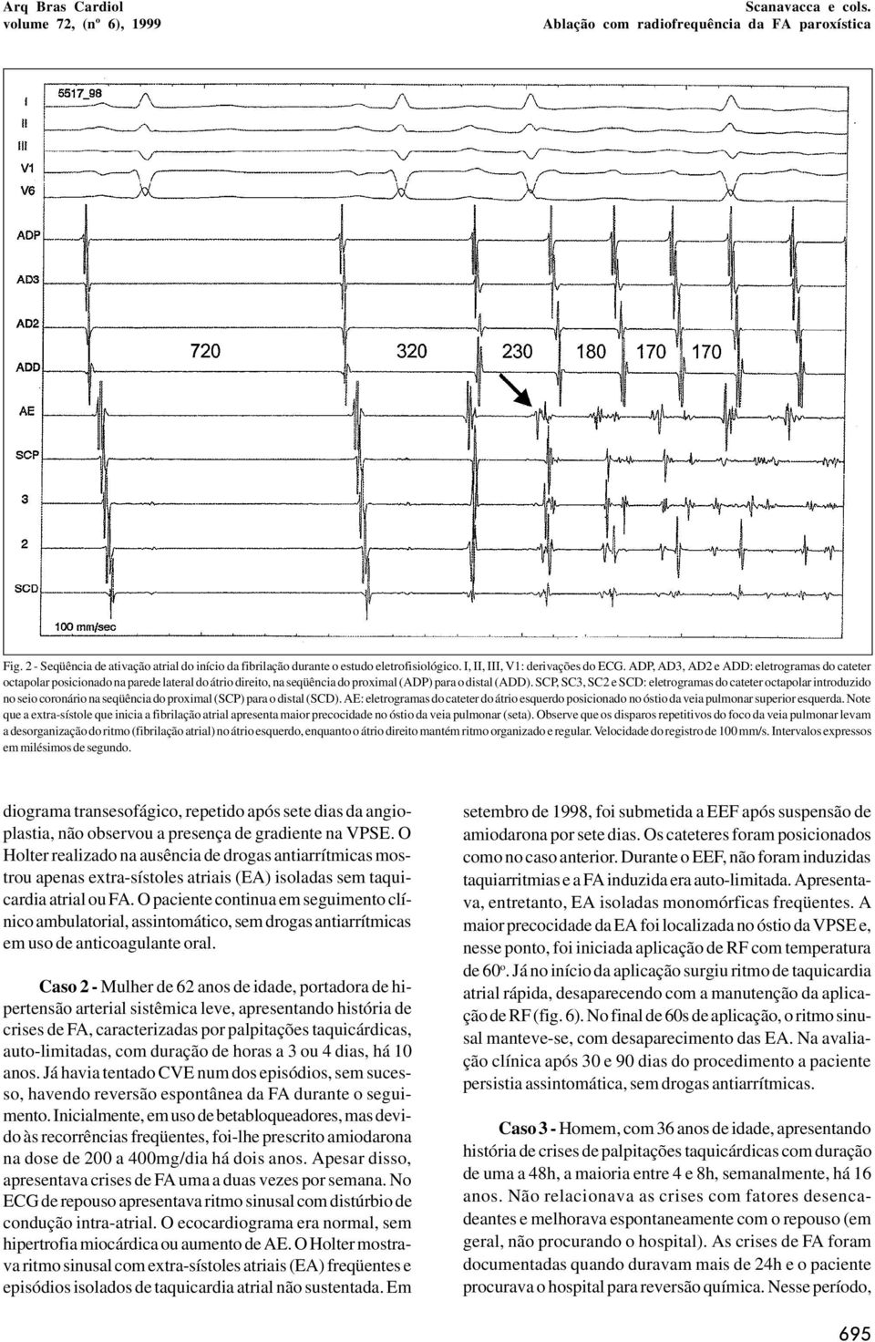 SCP, SC3, SC2 e SCD: eletrogramas do cateter octapolar introduzido no seio coronário na seqüência do proximal (SCP) para o distal (SCD).