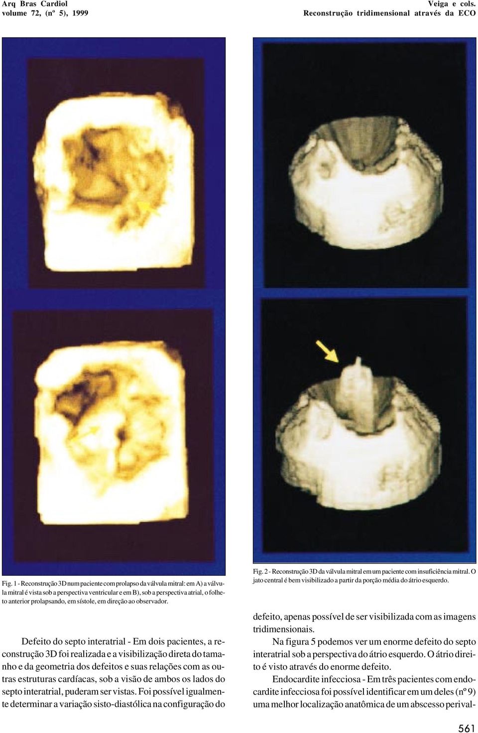 Defeito do septo interatrial - Em dois pacientes, a reconstrução 3D foi realizada e a visibilização direta do tamanho e da geometria dos defeitos e suas relações com as outras estruturas cardíacas,