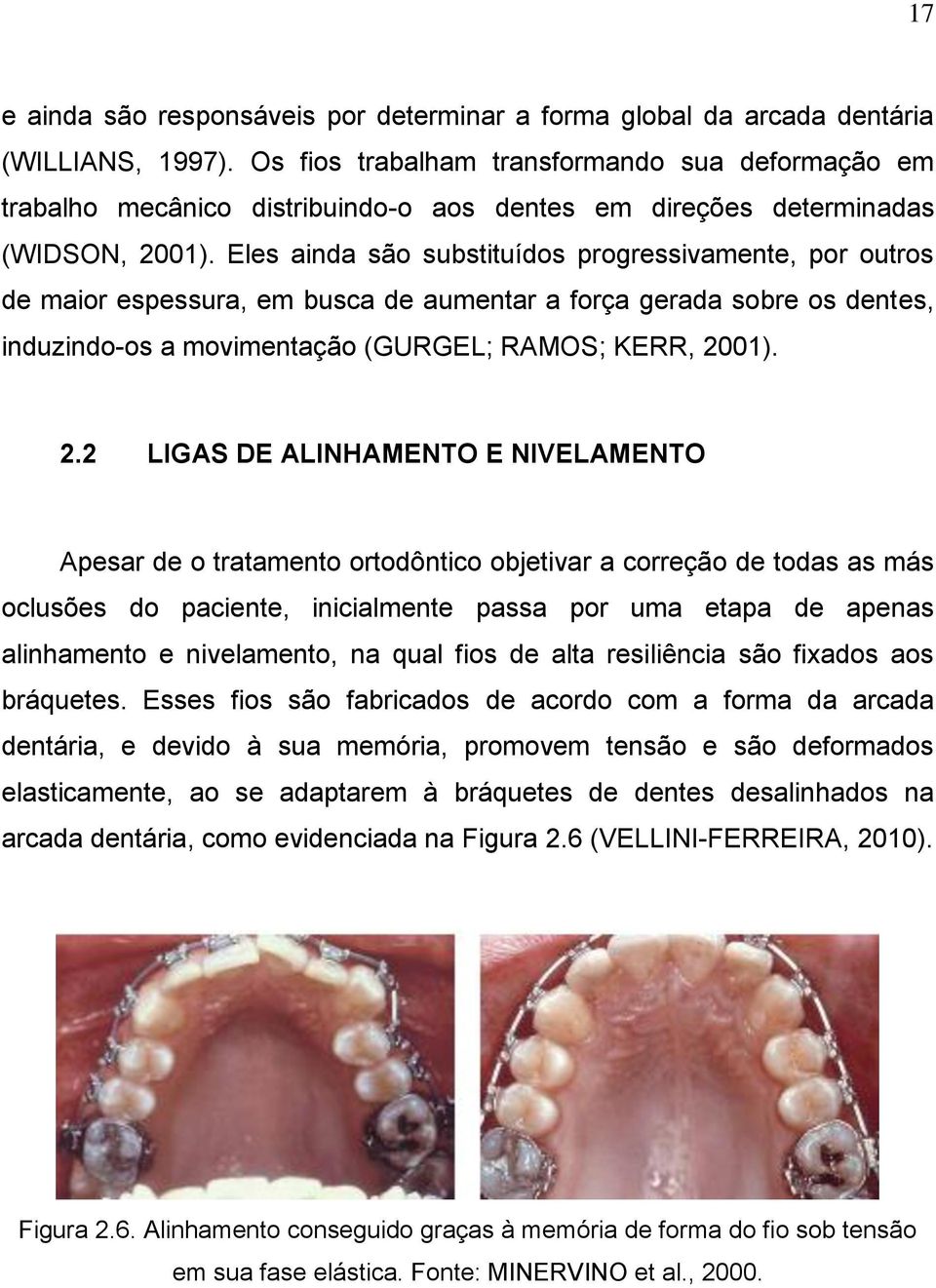 Eles ainda são substituídos progressivamente, por outros de maior espessura, em busca de aumentar a força gerada sobre os dentes, induzindo-os a movimentação (GURGEL; RAMOS; KERR, 20