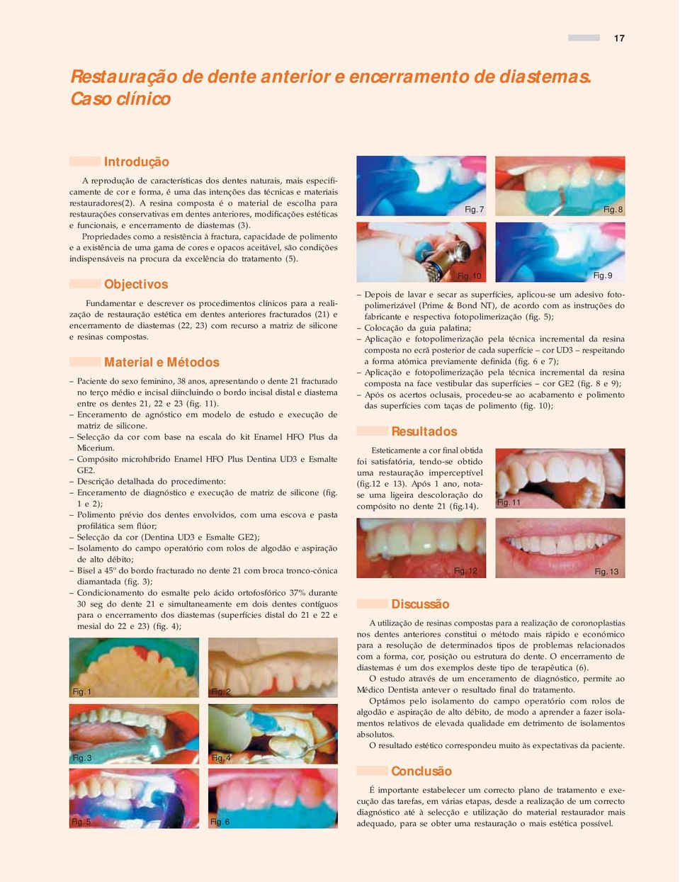 A resina composta é o material de escolha para restaurações conservativas em dentes anteriores, modificações estéticas e funcionais, e encerramento de diastemas (3).
