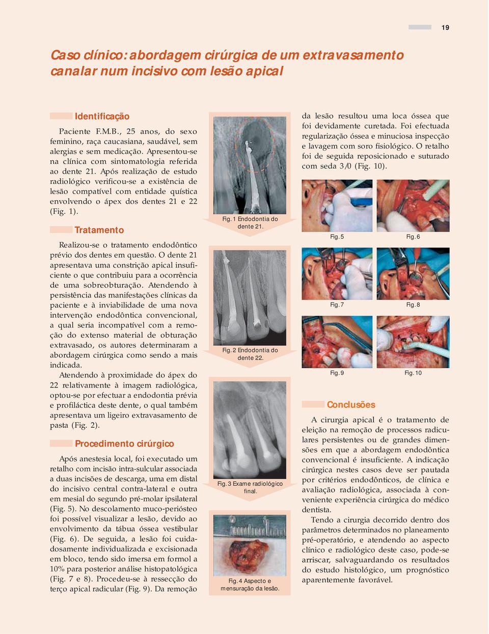 Após realização de estudo radiológico verificou-se a existência de lesão compatível com entidade quística envolvendo o ápex dos dentes 21 e 22 (Fig. 1).