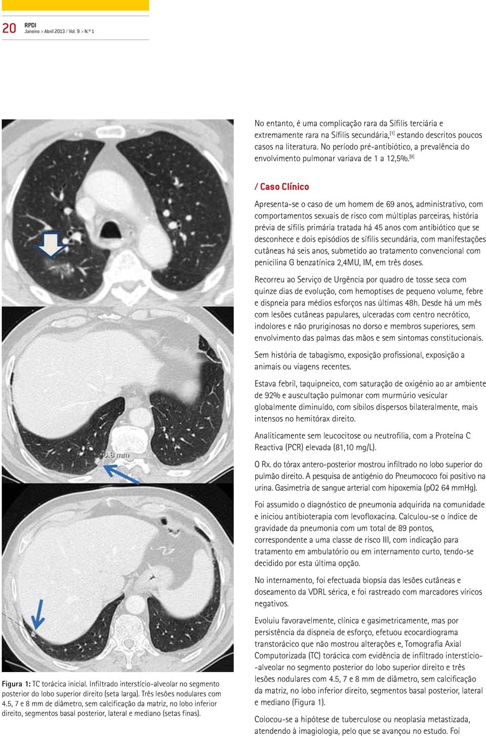 Infiltrado interstício-alveolar no segmento posterior do lobo superior direito (seta larga). Três lesões nodulares com 4.