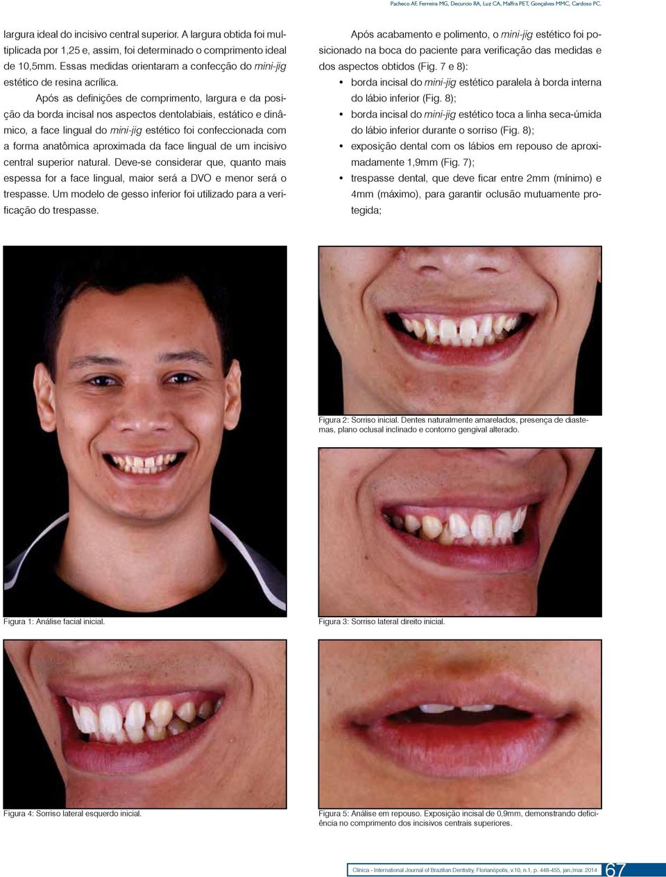 Após as definições de comprimento, largura e da posição da borda incisal nos aspectos dentolabiais, estático e dinâmico, a face lingual do mini-jig estético foi confeccionada com a forma anatômica