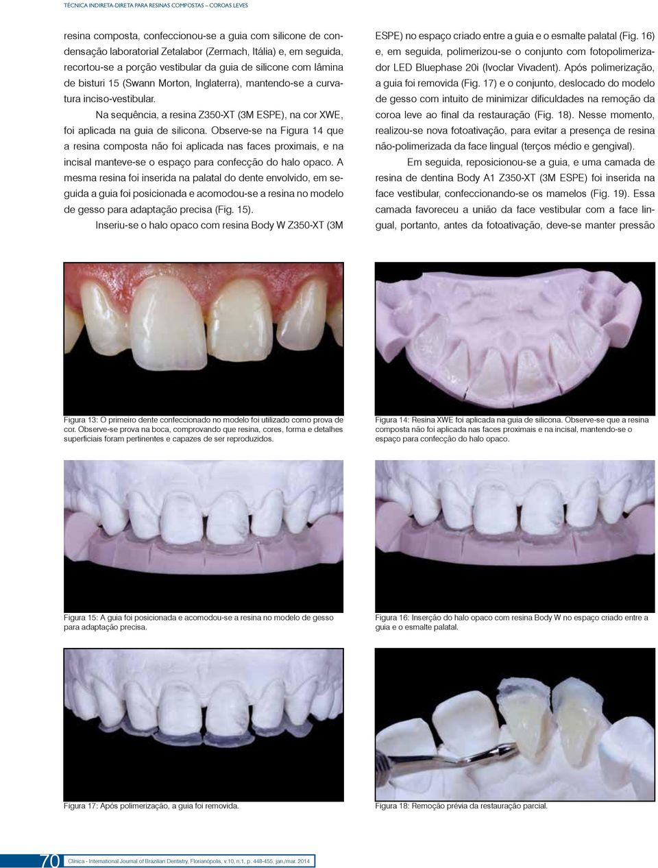 Na sequência, a resina Z350-XT (3M ESPE), na cor XWE, foi aplicada na guia de silicona.