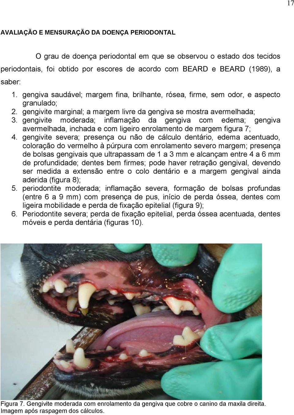 gengivite moderada; inflamação da gengiva com edema; gengiva avermelhada, inchada e com ligeiro enrolamento de margem figura 7; 4.