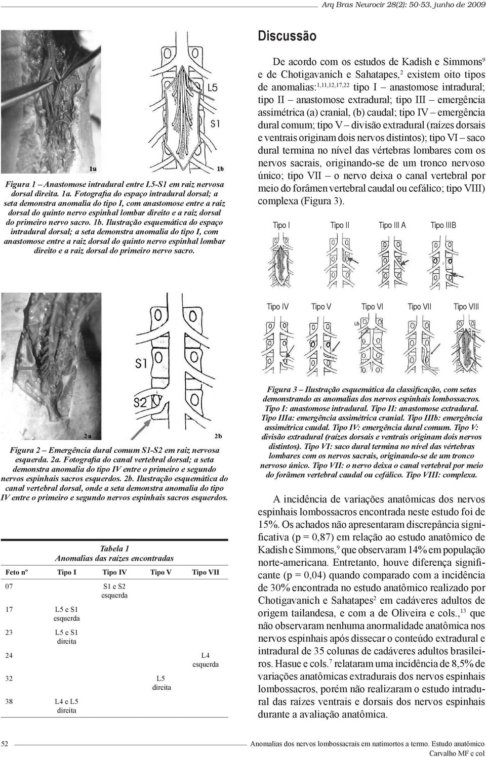 Ilustração esquemática do espaço intradural dorsal; a seta demonstra anomalia do tipo I, com anastomose entre a raiz dorsal do quinto nervo espinhal lombar direito e a raiz dorsal do primeiro nervo