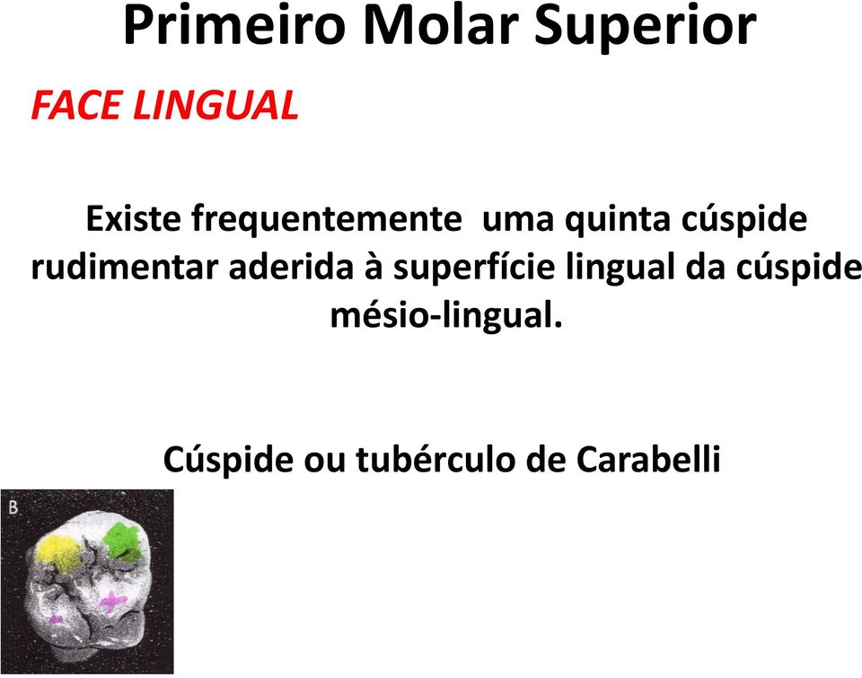 superfície lingual da cúspide