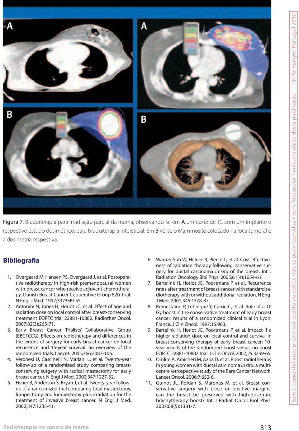 Postoperative radiotherapy in high-risk premenopausal women with breast cancer who receive adjuvant chemotherapy. Danish Breast Cancer Cooperative Group 82b Trial. N Engl J Med. 1997;337:949-55. 2.