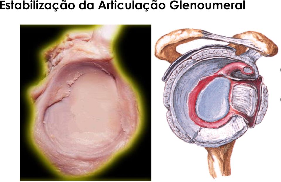 profundidade da glenóide (Warner, 1993) Uma