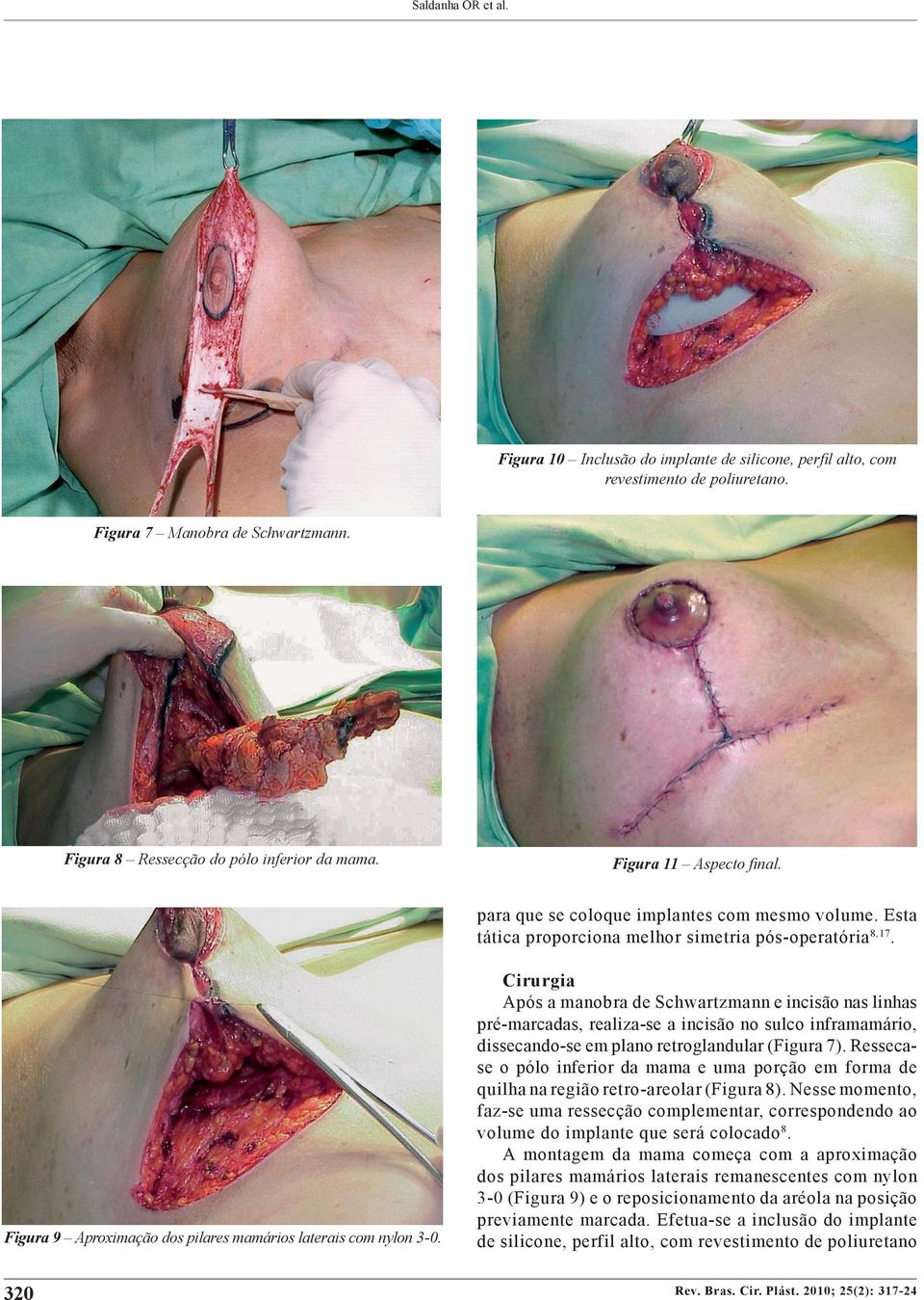 320 Cirurgia Após a manobra de Schwartzmann e incisão nas linhas pré-marcadas, realiza-se a incisão no sulco inframamário, dissecando-se em plano retroglandular (Figura 7).