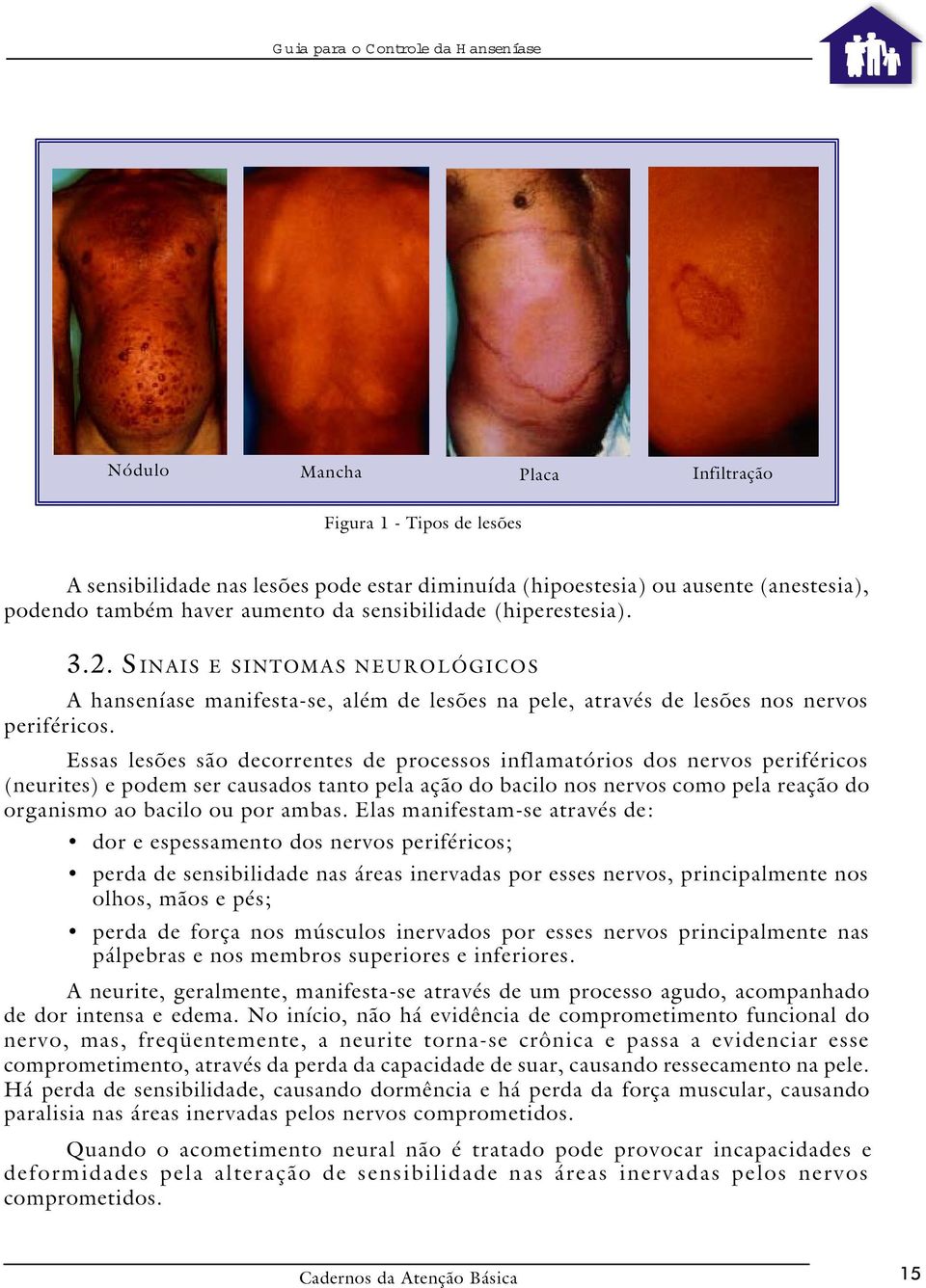 Essas lesões são decorrentes de processos inflamatórios dos nervos periféricos (neurites) e podem ser causados tanto pela ação do bacilo nos nervos como pela reação do organismo ao bacilo ou por