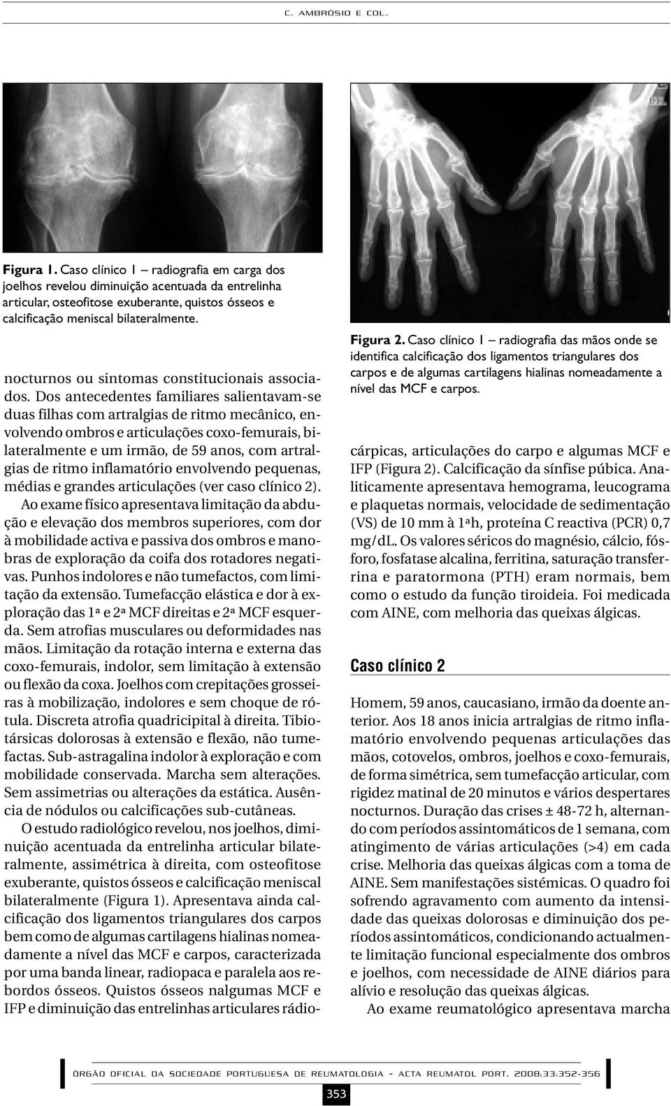 Caso clínico 1 radiografia das mãos onde se identifica calcificação dos ligamentos triangulares dos carpos e de algumas cartilagens hialinas nomeadamente a nível das MCF e carpos.