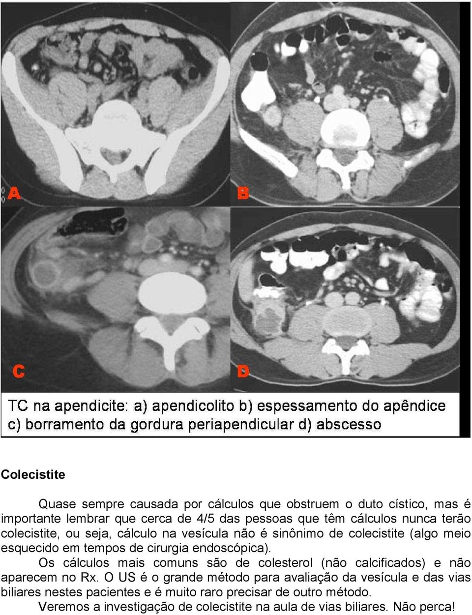 endoscópica). Os cálculos mais comuns são de colesterol (não calcificados) e não aparecem no Rx.