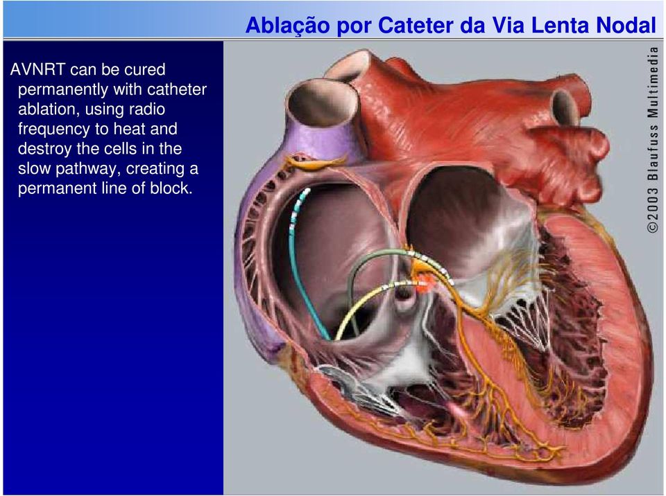 destroy the cells in the slow pathway, creating a