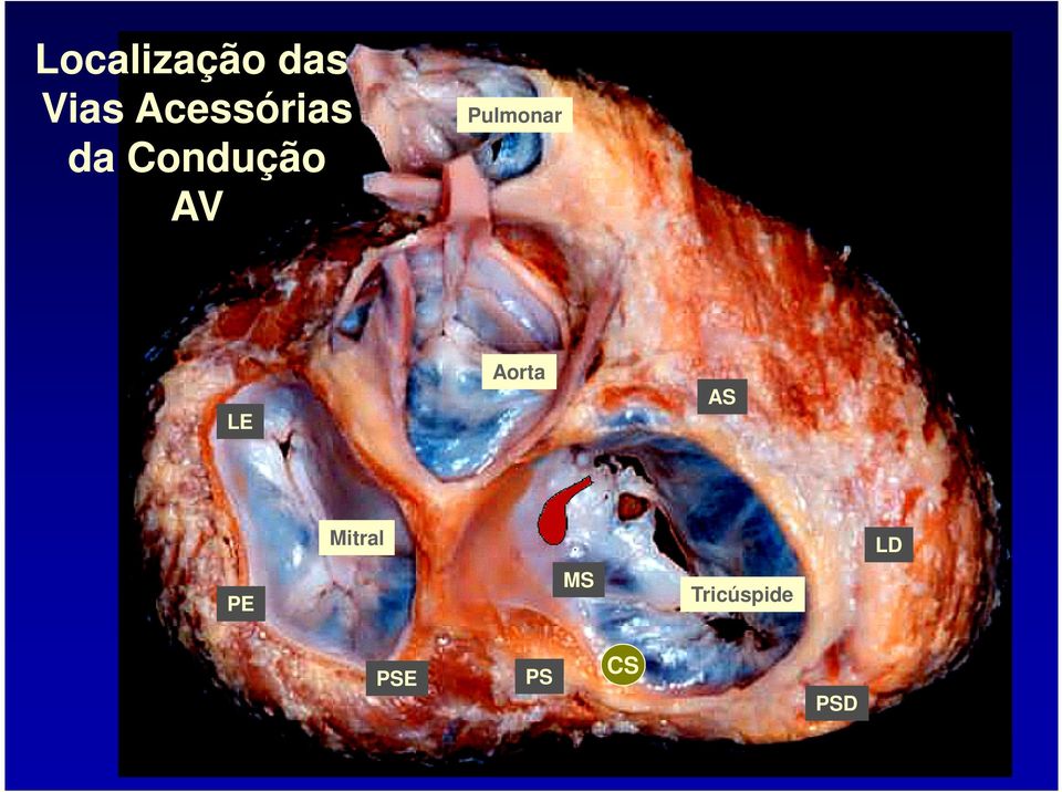 Pulmonar LE Aorta AS