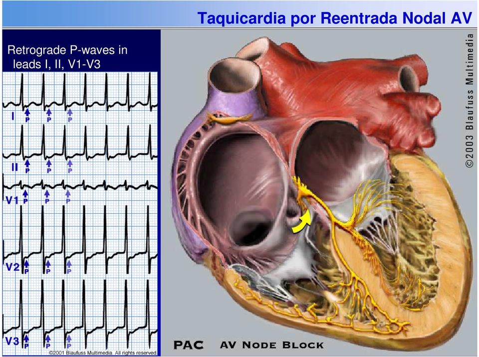 V1-V3 Taquicardia