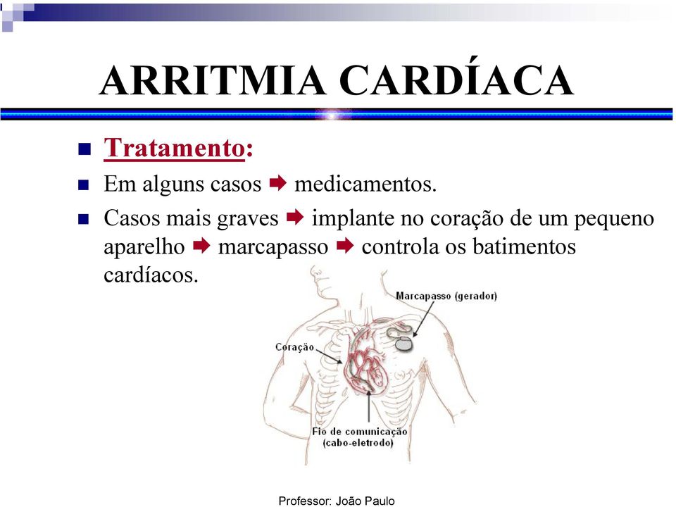 Casos mais graves implante no coração de um