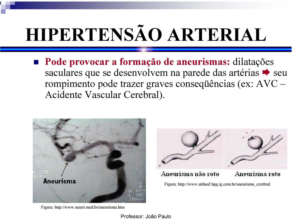 graves conseqüências (ex: AVC Acidente Vascular Cerebral). Figura: http://www.