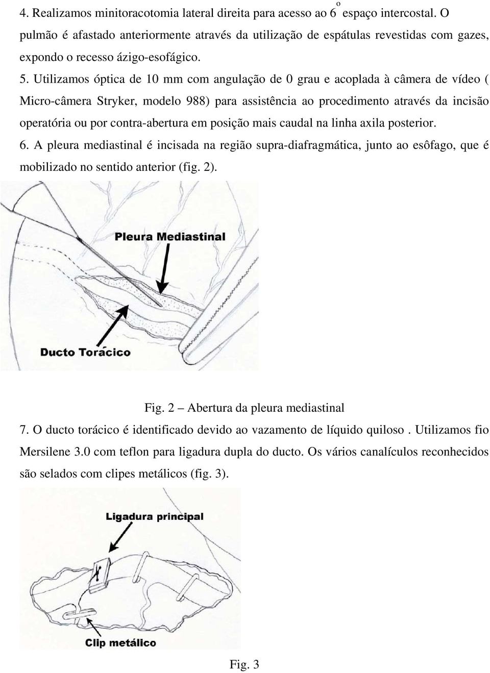 Utilizamos óptica de 10 mm com angulação de 0 grau e acoplada à câmera de vídeo ( Micro-câmera Stryker, modelo 988) para assistência ao procedimento através da incisão operatória ou por