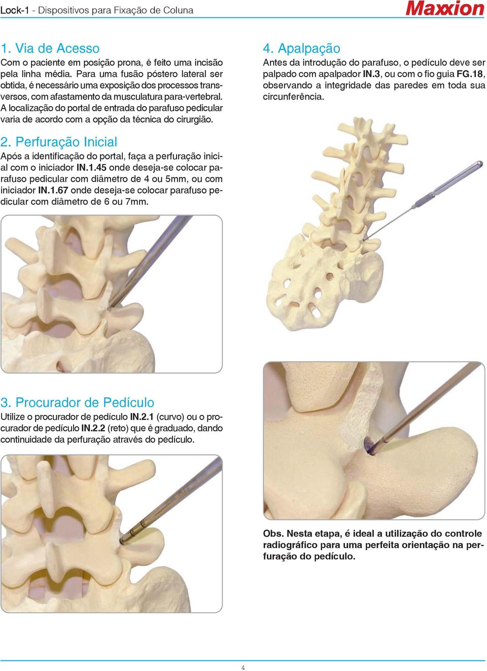 A localização do portal de entrada do parafuso pedicular varia de acordo com a opção da técnica do cirurgião. 4.