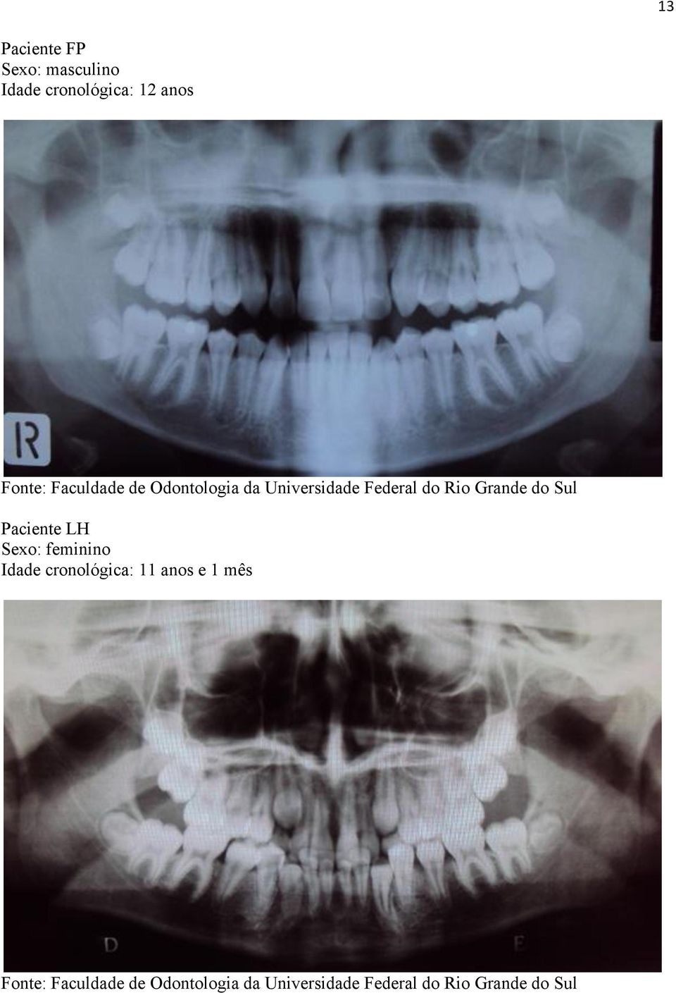 Sul Paciente LH Sexo: feminino Idade cronológica: 11 anos e 1 mês