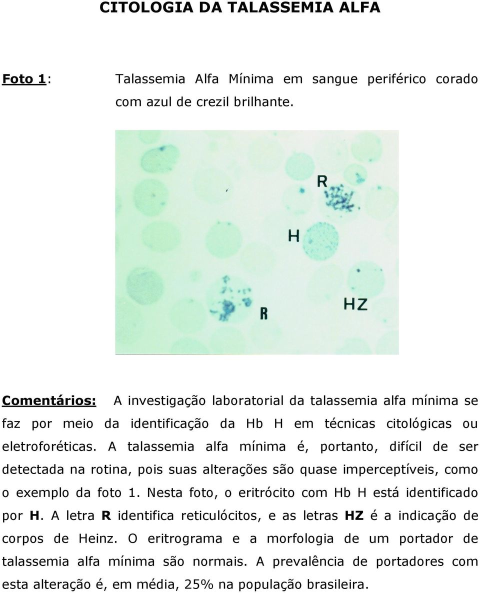 A talassemia alfa mínima é, portanto, difícil de ser detectada na rotina, pois suas alterações são quase imperceptíveis, como o exemplo da foto 1.