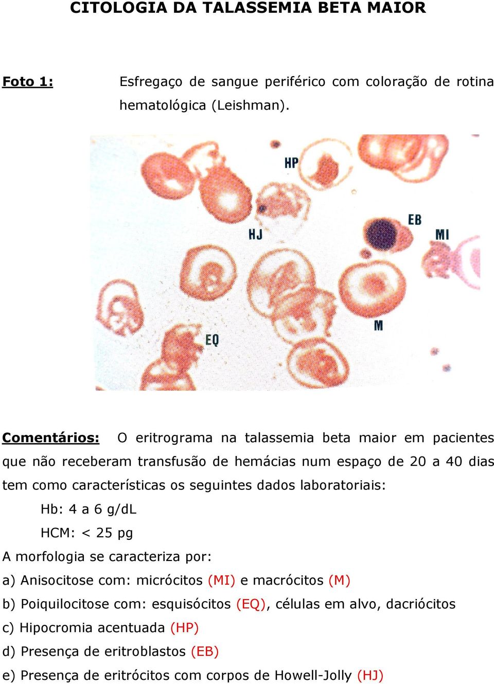 características os seguintes dados laboratoriais: Hb: 4 a 6 g/dl HCM: < 25 pg A morfologia se caracteriza por: a) Anisocitose com: micrócitos (MI) e