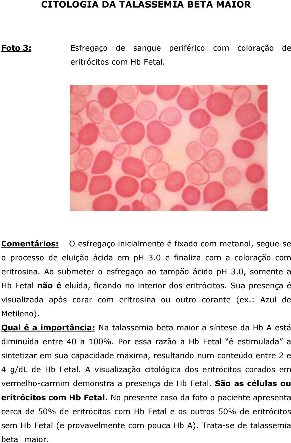 0, somente a Hb Fetal não é eluída, ficando no interior dos eritrócitos. Sua presença é visualizada após corar com eritrosina ou outro corante (ex.: Azul de Metileno).