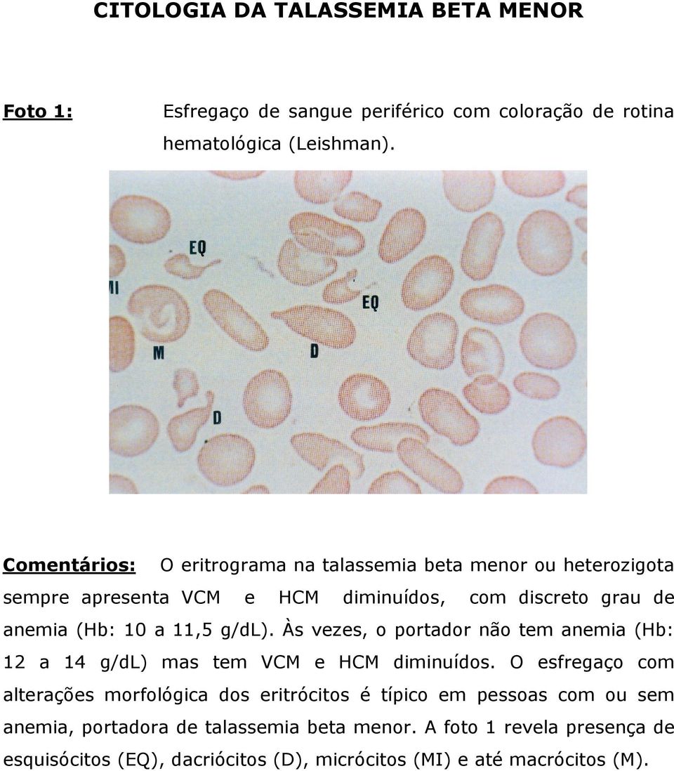 11,5 g/dl). Às vezes, o portador não tem anemia (Hb: 12 a 14 g/dl) mas tem VCM e HCM diminuídos.