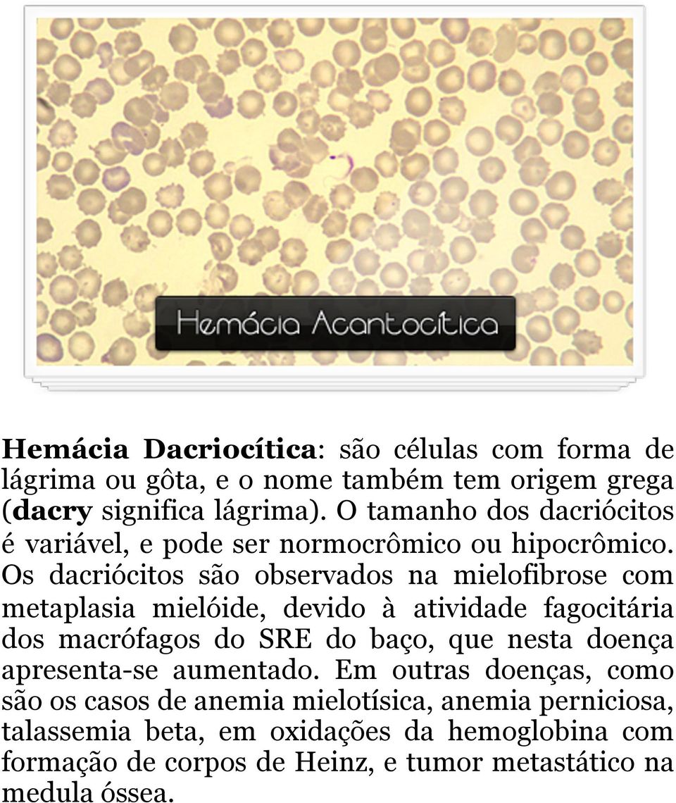 Os dacriócitos são observados na mielofibrose com metaplasia mielóide, devido à atividade fagocitária dos macrófagos do SRE do baço, que nesta