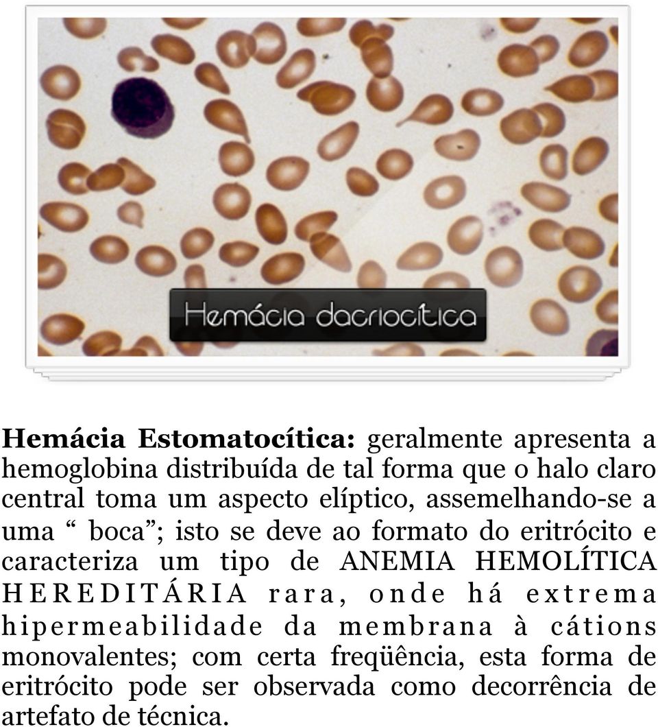 tipo de ANEMIA HEMOLÍTICA HEREDITÁRIA rara, onde há extrema hipermeabilidade da membrana à cátions