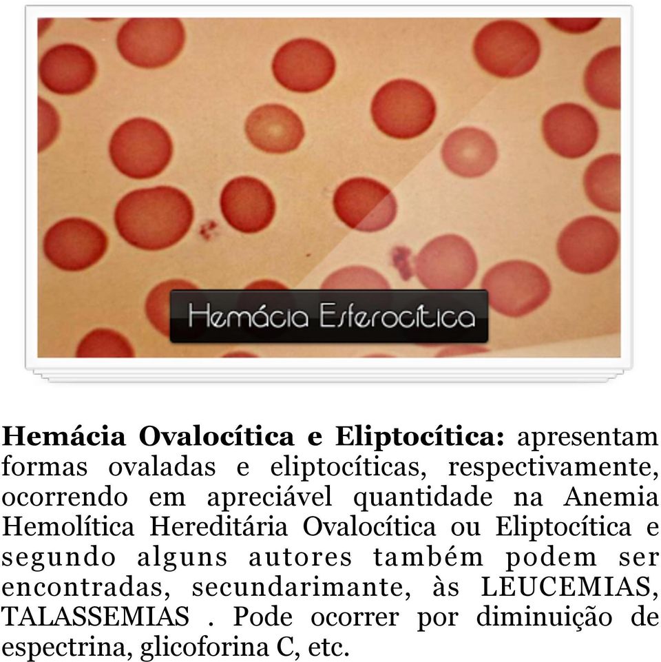 Ovalocítica ou Eliptocítica e segundo alguns autores também podem ser encontradas,