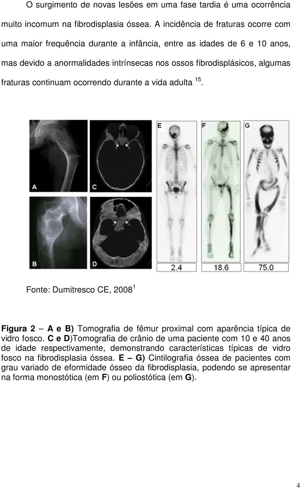 continuam ocorrendo durante a vida adulta 15. Fonte: Dumitresco CE, 2008 1 Figura 2 A e B) Tomografia de fêmur proximal com aparência típica de vidro fosco.