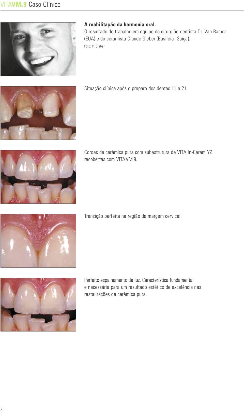 Coroas de cerâmica pura com subestrutura de VITA In-Ceram YZ recobertas com VITAVM 9.